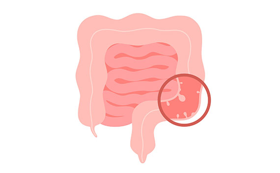 Read more about the article What Are Polyps?