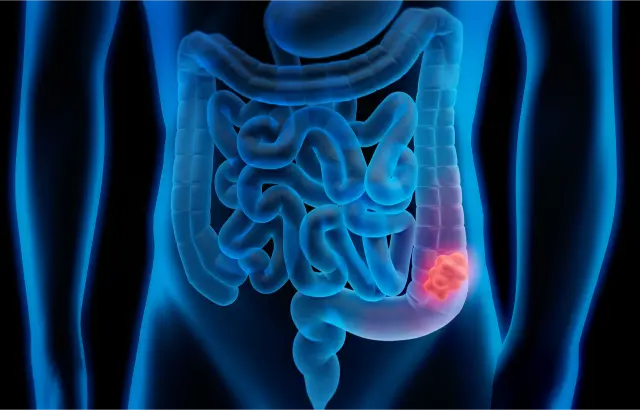 Read more about the article Understanding the Importance of Colorectal Cancer Screening: A Vital Step for Better Health