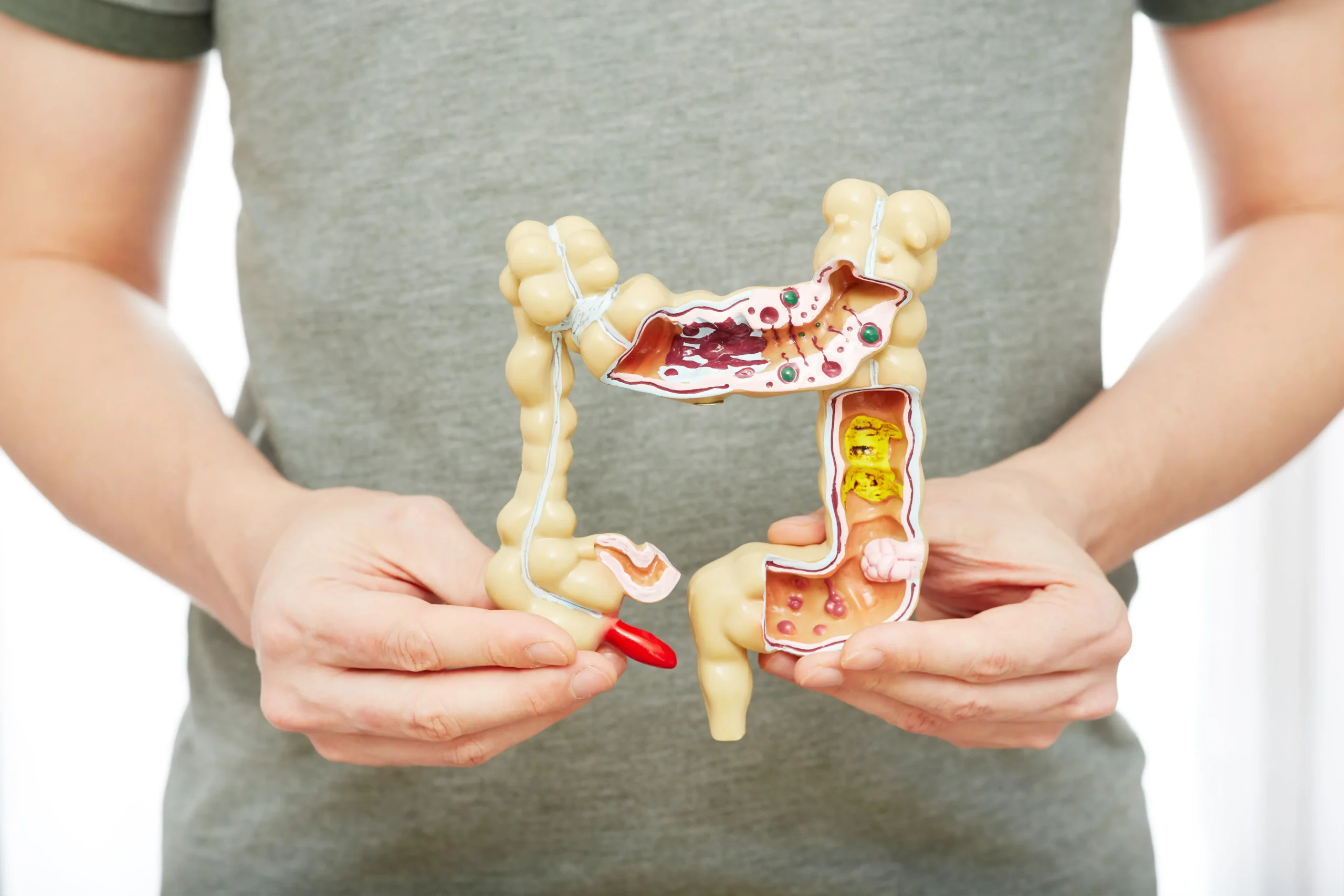 Understanding and Managing Pain Associated With Ulcerative Colitis